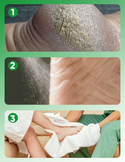 Spray Anti-Callosités pour les Pieds